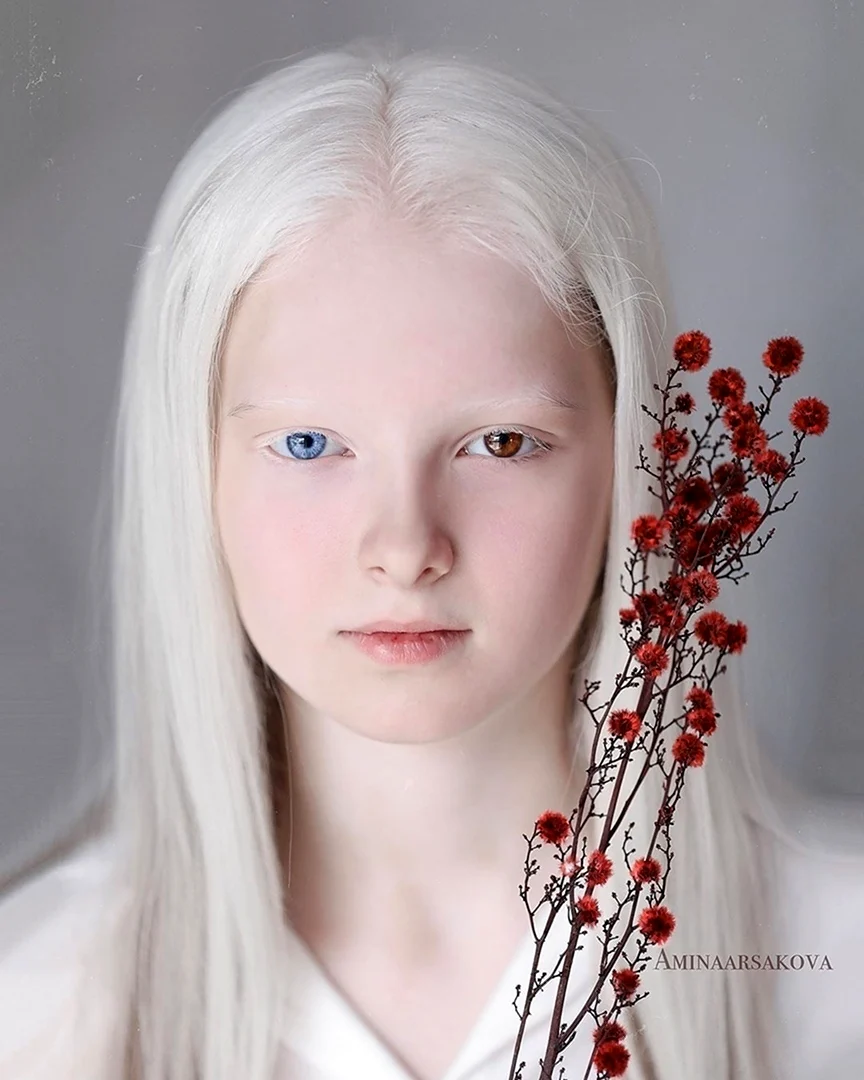 Амина Эпендиева альбинос