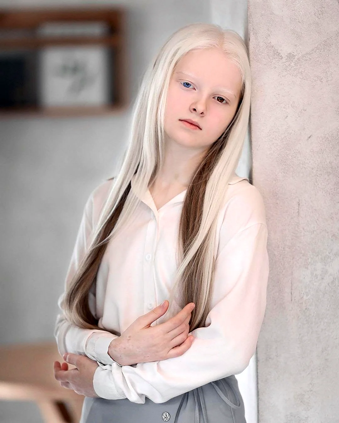 Амина Эпендиева альбинос