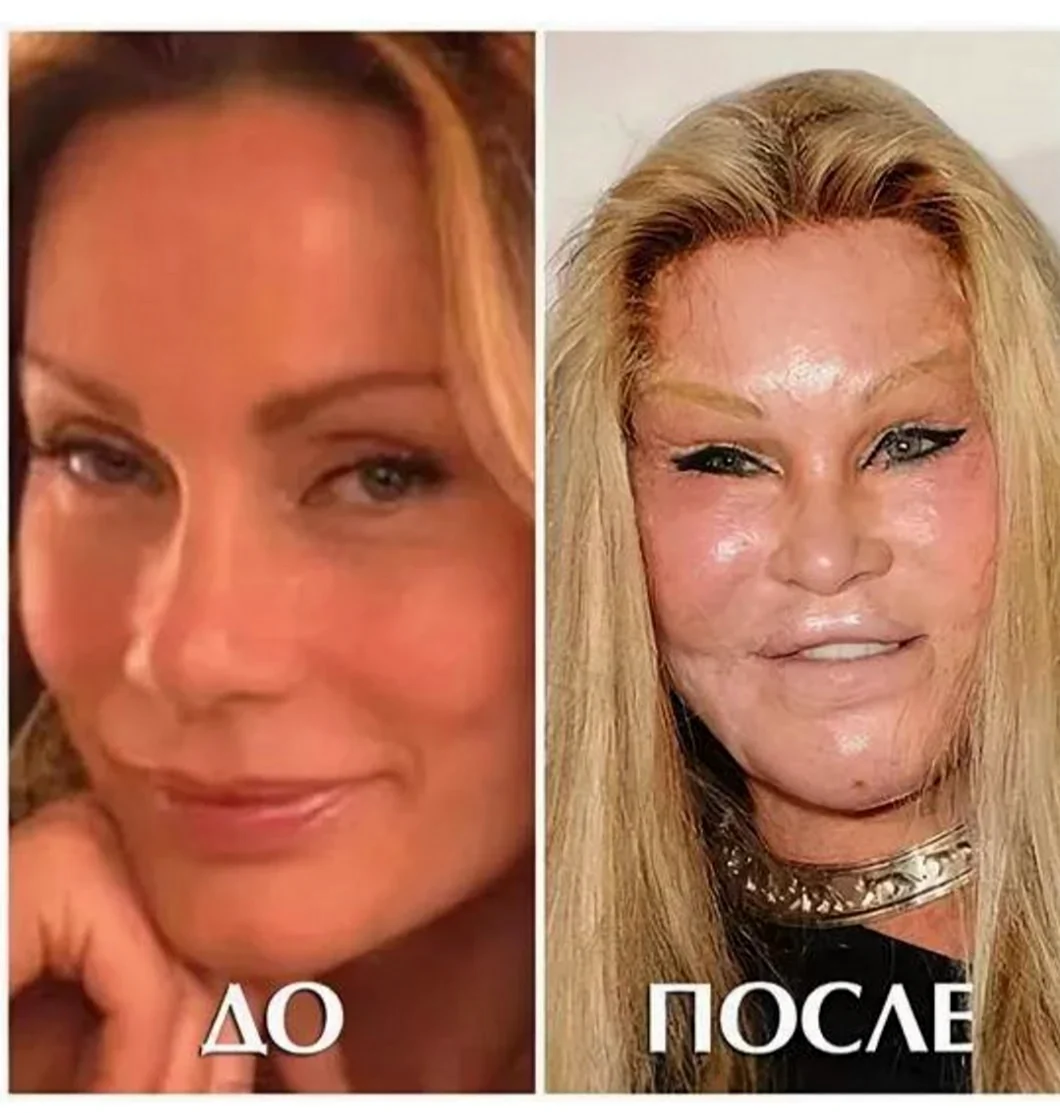 Джослин Вильденштейн до пластики